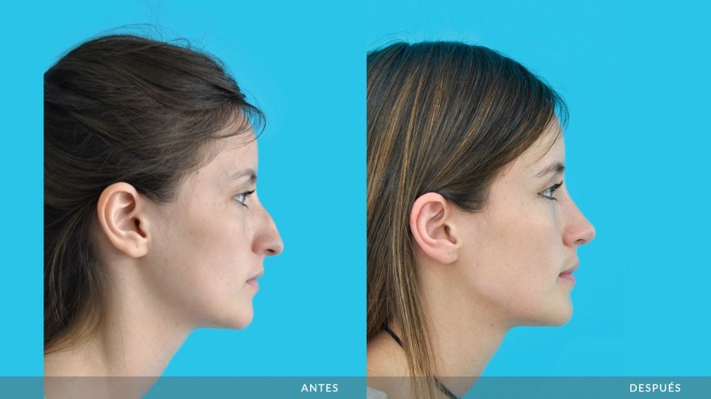 Rinoplastia Antes y Después